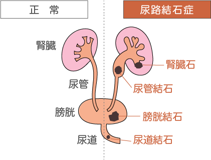 尿路結石の症状イメージ