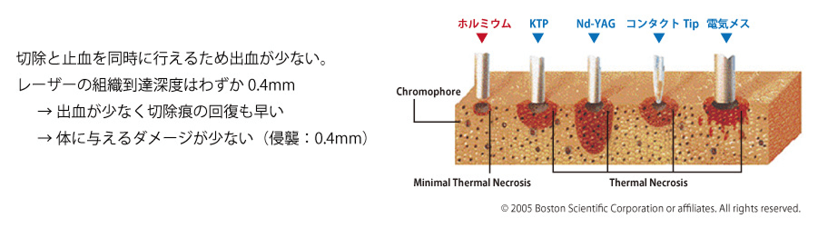 ホルミウムレーザーの特性