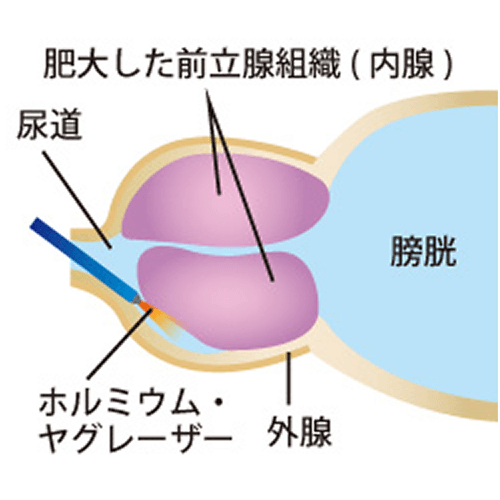 ホルミウムレーザーの特性-1
