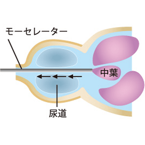 ホルミウムレーザーの特性-3