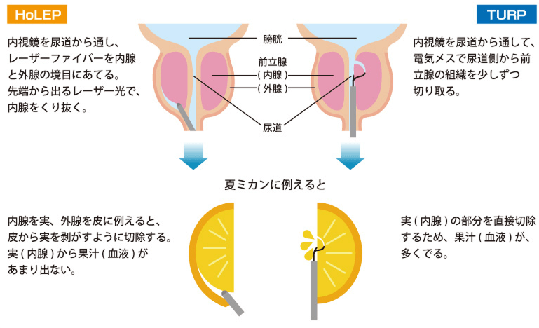 従来型手術（経尿道的前立腺切除術：TURP）との比較