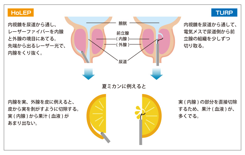 内視鏡を尿道から通し、レーザーファイバーを内腺と外腺の境目にあてる。先端から出るレーザー光で、内腺をくり抜く。
内視鏡を尿道から通して、電気メスで尿道側から前立腺の組織を少しずつ切り取る。
内腺を実、外腺を皮に例えると、皮から実を剥がすように切除する。実(内腺)から果汁(血液)があまり出ない。
実(内腺)の部分を直接切除するため、果汁(血液)が、多くでる。