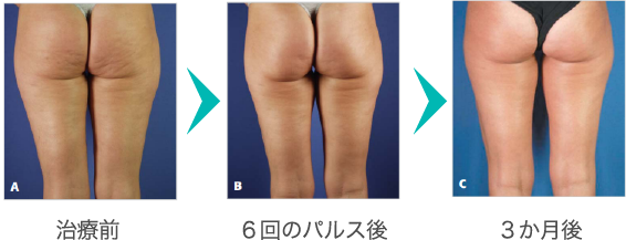 写真：例）大腿部外側の治療（43歳・女性）