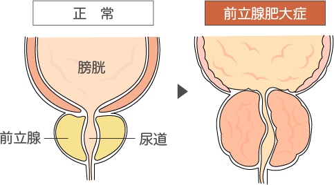 前立腺肥大症の症状イメージ