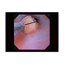 経尿道的尿路結石砕石術（TUL）