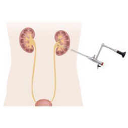 経皮的尿路結石砕石術（PNL）