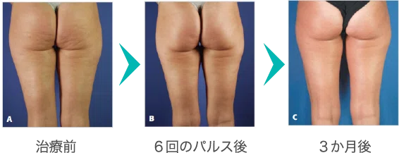 例）大腿部外側の治療（43歳・女性）